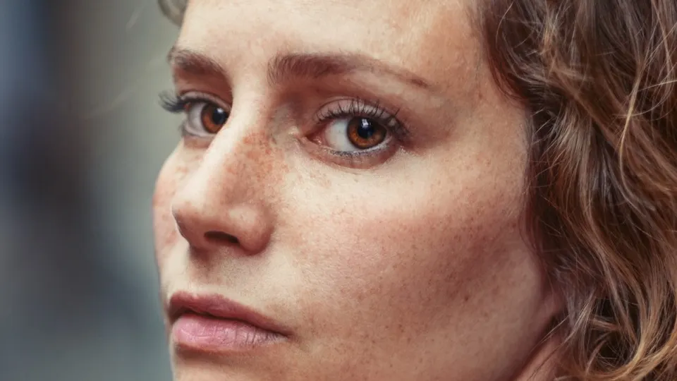 Rostro femenino para comparar Botox y ácido hialurónico