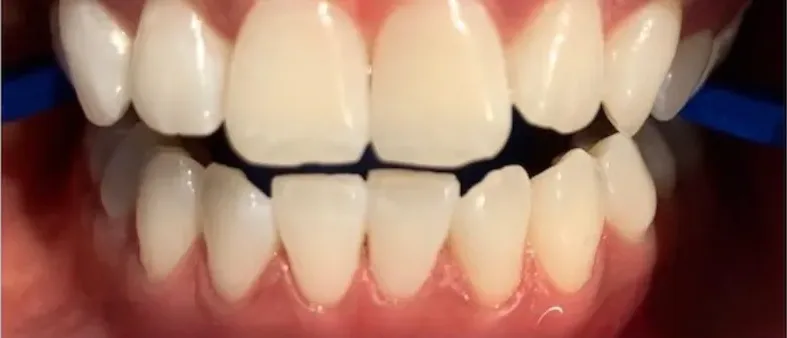 Dientes amarillentos antes de un blanqueamiento dental en consultorio