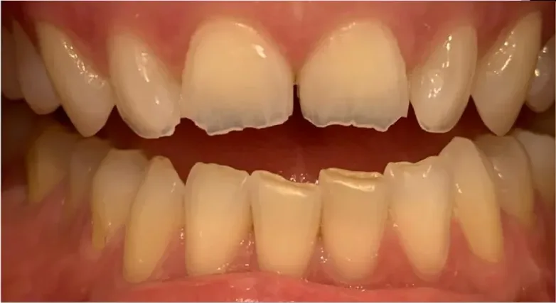 Dientes desgastados y amarillentos antes de las carillas dentales