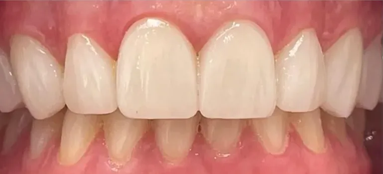 Sonrisa transformada con carillas dentales y diseño de sonrisa