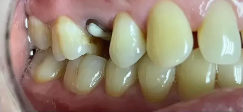 Piezas laterales deterioradas antes de la prótesis dental fija