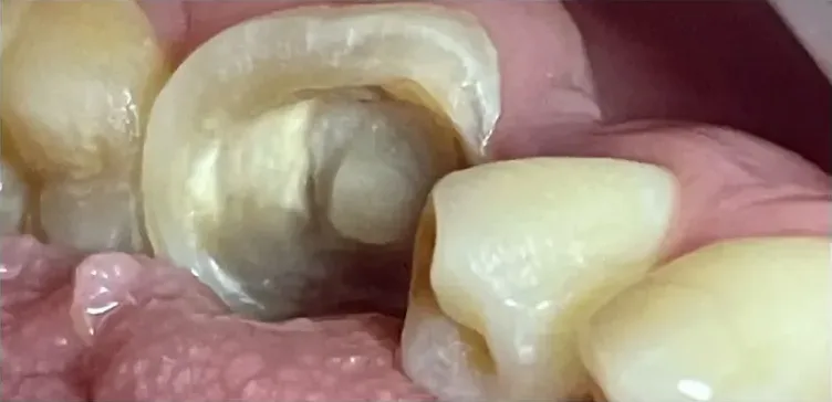 Muela posterior dañada antes de la restauración dental