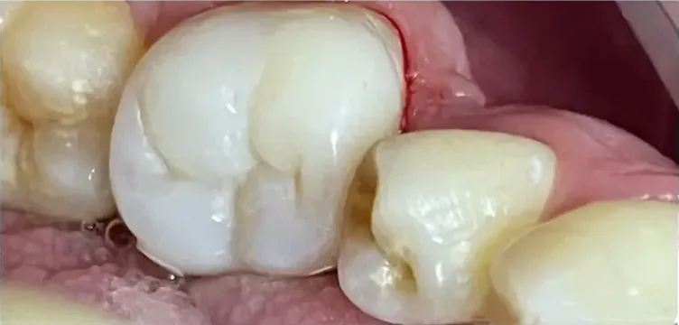 Muela restaurada con resina estética