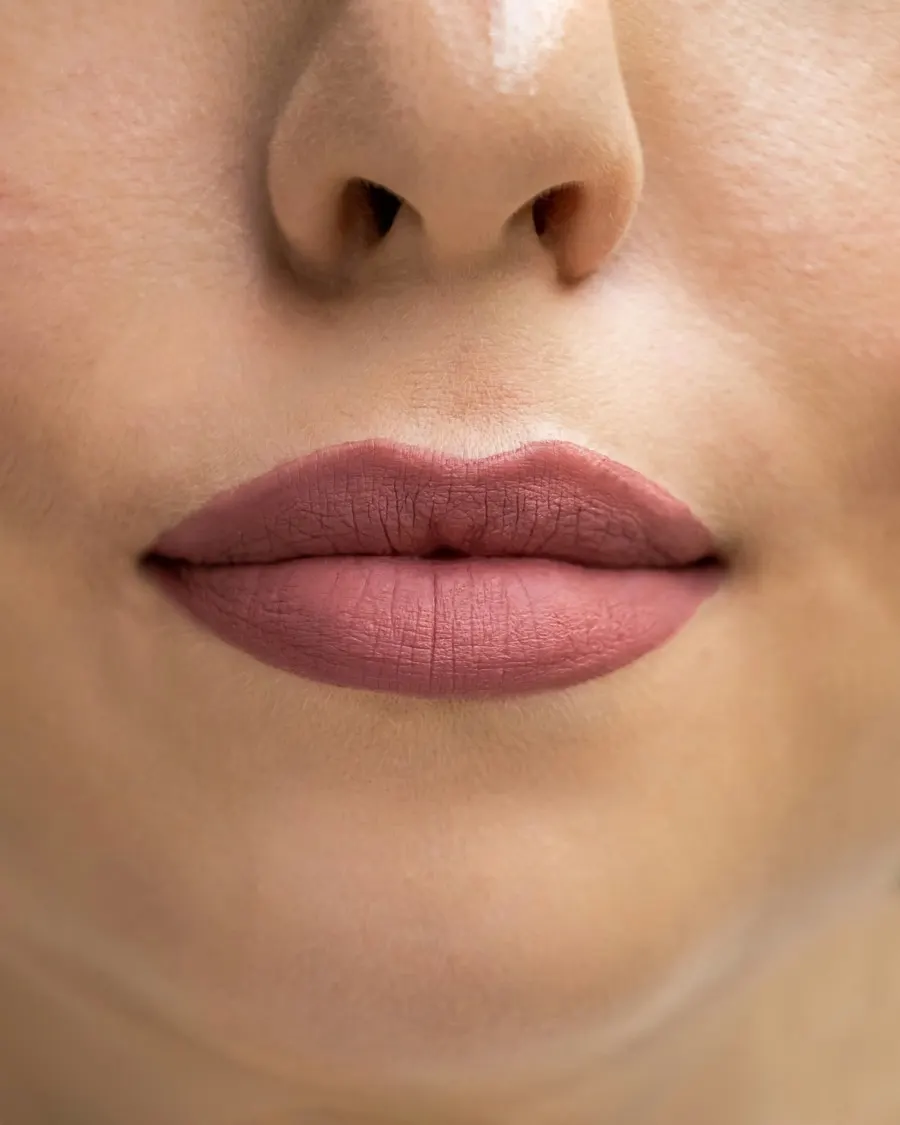 Tratamiento de relleno de labios con ácido hialurónico en Valencia